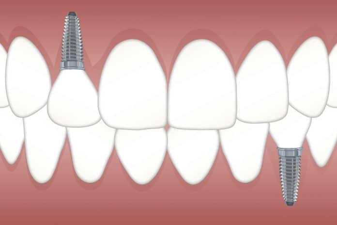 Durée de vie d un implant dentaire